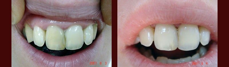 Przed / Po: Wybielanie gabinetowe w tym pojedynczych martwych zębów