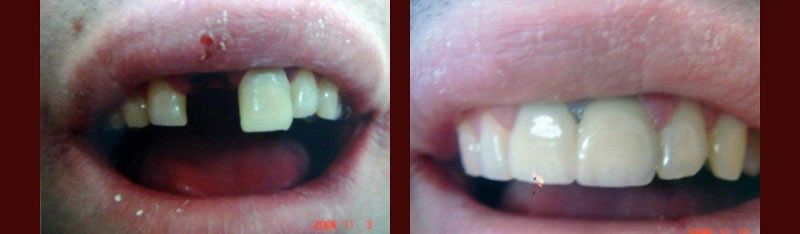 Przed / Po: Różne: wybicie zęba - półmost