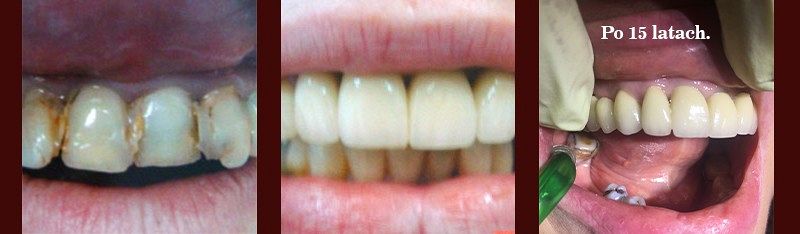Przed / Po: Różne: zęby paradontalne/zszynowane mostem porcelanowym
