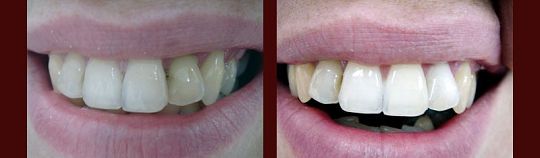 Przed / Po: Wybielanie gabinetowe w tym pojedynczych martwych zębów