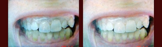 Przed / Po: Wybielanie w trakcie zabiegu (wybielanie tylko górnego łuku)